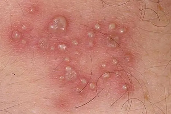 Bị nổi nốt ngứa ở bìu tinh hoàn do Bệnh mụn rộp sinh dục