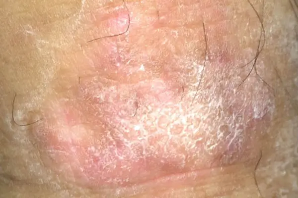 Bị nổi nốt ngứa ở bìu tinh hoàn do Bệnh chàm bìu