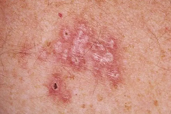 Bị nổi nốt ngứa ở bìu tinh hoàn do nấm bìu