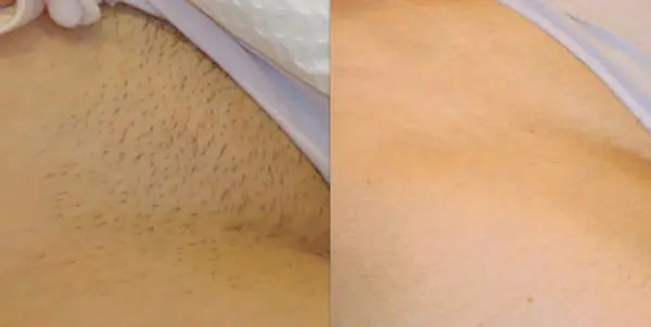 Hình ảnh vùng kín không có lông mu do cạo & triệt lông