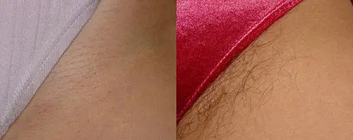 Hình ảnh vùng kín không có lông