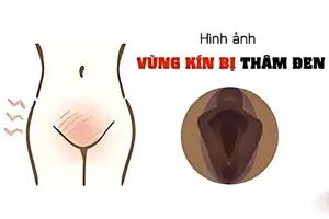 Tại Sao Vùng Kín Bị Thâm Khi Chưa Quan Hệ? Bật Mí Nguyên Nhân Và Cách Khắc Phục