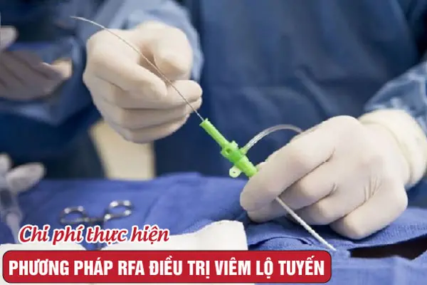 Phương pháp RFA điều trị viêm lộ tuyến giá bao nhiêu? Bảng giá 2026