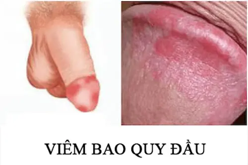 Bao quy đầu bị ngứa rát do viêm bao quy đầu