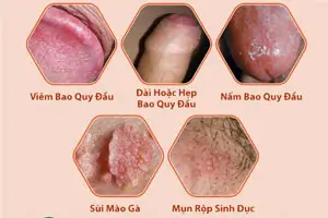 Sau khi quan hệ dương vật bị sưng ngứa đau rát là tại sao? Nguyên nhân cách chữa