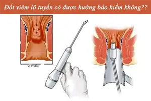 Đốt viêm lộ tuyến có được hưởng bảo hiểm không?