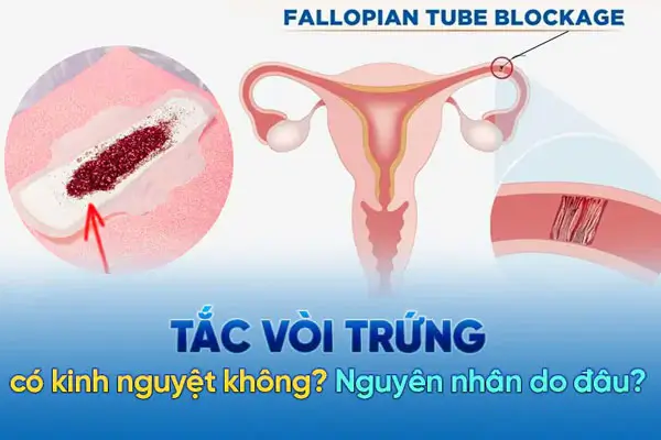 Tắc vòi trứng có kinh nguyệt không? BÁC SĨ giải đáp