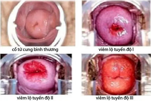 Chữa viêm lộ tuyến cổ tử cung ở Phòng khám đa khoa Thái Hà