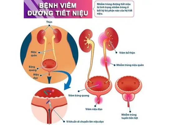 Biểu hiện Viêm đường tiết niệu ở nam, nữ giới sớm, chính xác nhất