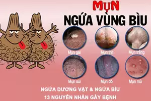 Ngứa dương vật và Ngứa bìu: 19 Nguyên nhân & Cách điều trị tại nhà hiệu quả