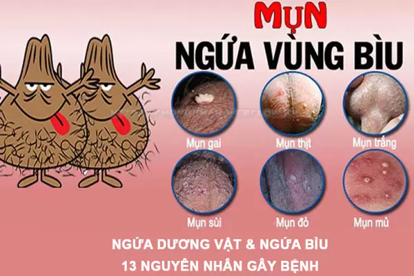 Ngứa dương vật & Ngứa bìu: Nguyên nhân & Cách điều trị tại nhà hiệu quả