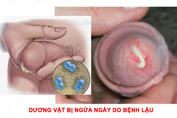 Dương vật bị ngứa ngáy do bệnh lậu