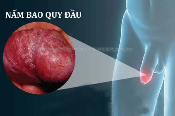 Ngứa dương vật cảnh báo bệnh Chlamydia