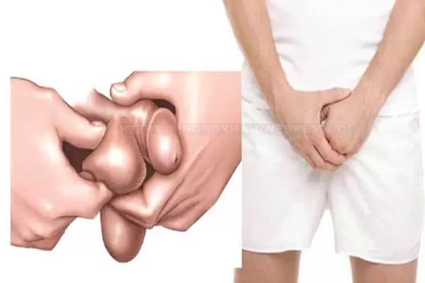 Cách điều trị ngứa dương vật, ngứa bìu tại nhà hiệu quả