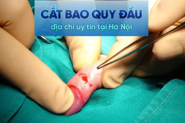 Review Top 10 Địa chỉ cắt bao quy đầu uy tín, an toàn nhất tại Hà Nội