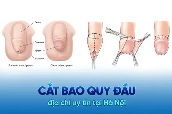 Top 10 Địa chỉ cắt bao quy đầu uy tín, an toàn nhất tại Hà Nội