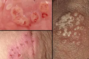 10+ Cách Chữa Bệnh Lậu Triệt Để, Đơn Giản Nhất: Từ Dân Gian Đến Công Nghệ DHA (2026)