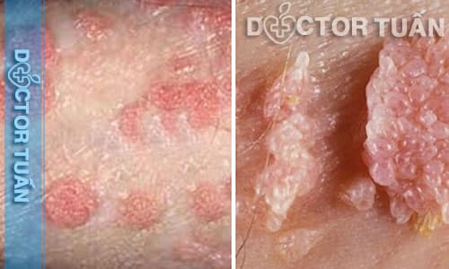 Bệnh sùi mào gà khiến dương vật nổi mụn