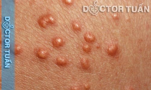 Dương vật bị nổi mụn do nấm