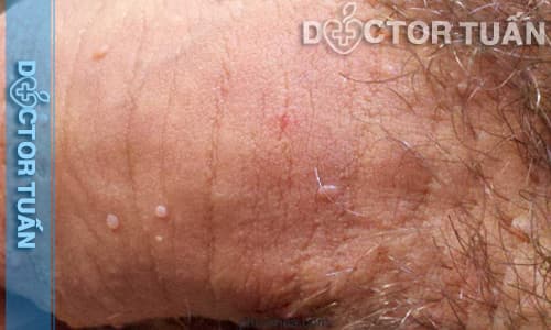 Dương vật nổi mụn do mụn rộp sinh dục