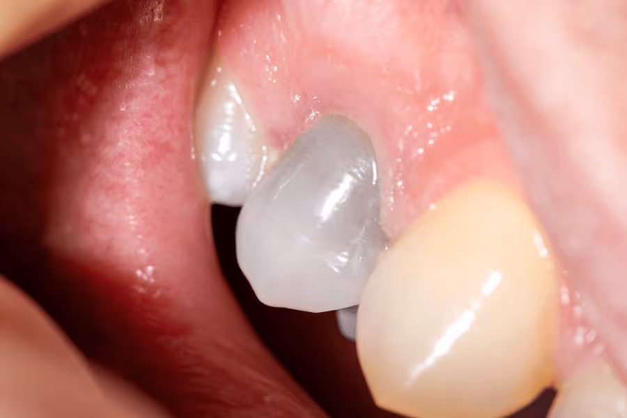 dente morto primadent