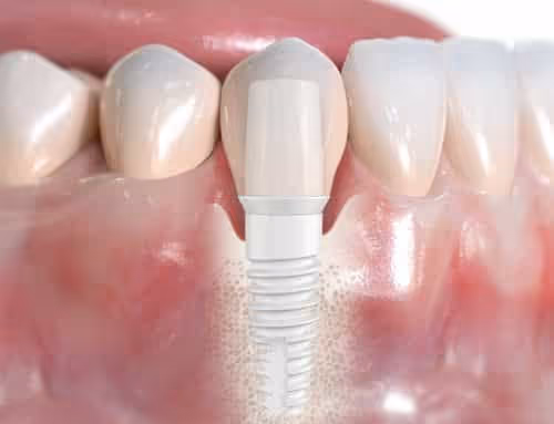 Primo piano di un dente in zirconio, all'interno di una bocca
