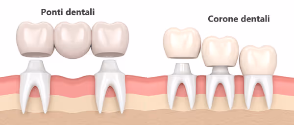 Immagine 3D di corone dentali e ponti dentali