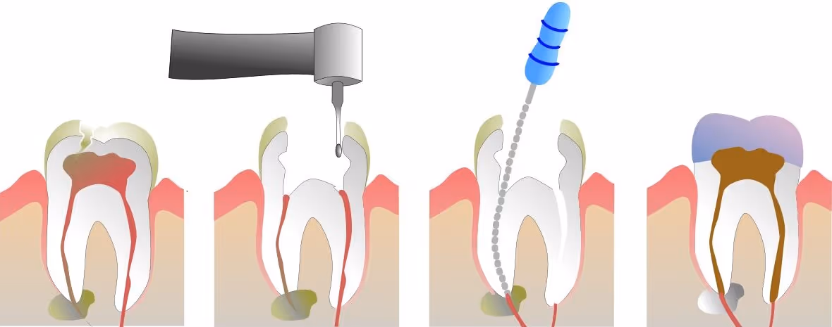 immagine rappresentativa dell'endodonzia