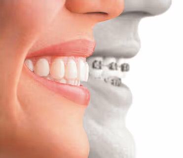 Confronto in laterale, sorriso con e senza apparecchio