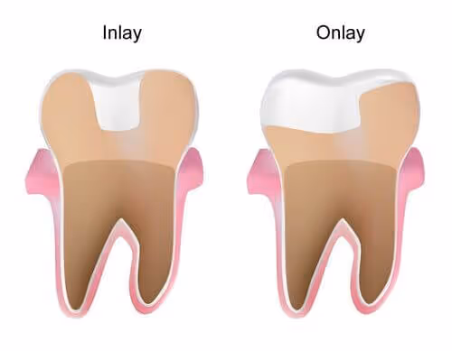 immagine differenza inlay onlay su due denti