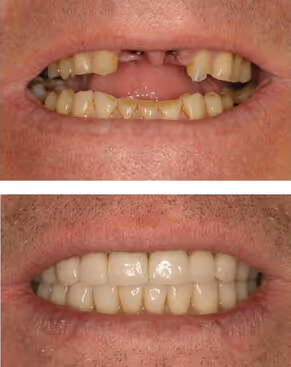 Immagine denti rovinati, e denti ripristinati dal dentista