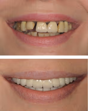 Immagine denti rovinati, e denti ripristinati dal dentista