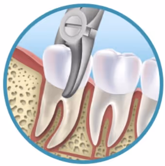 gif estrazione dentale