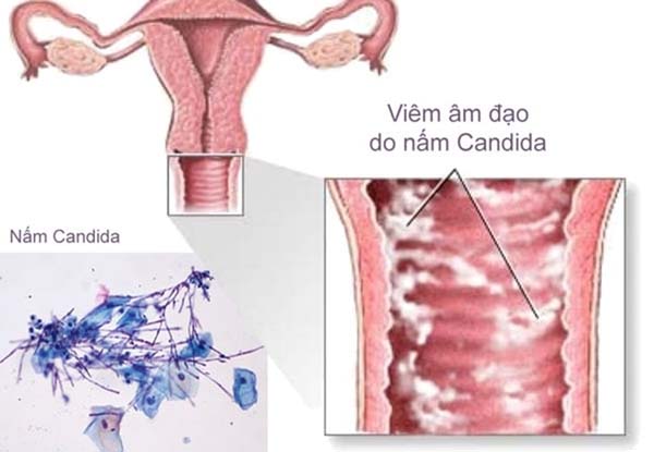 nấm candida gây viêm âm âm đạo