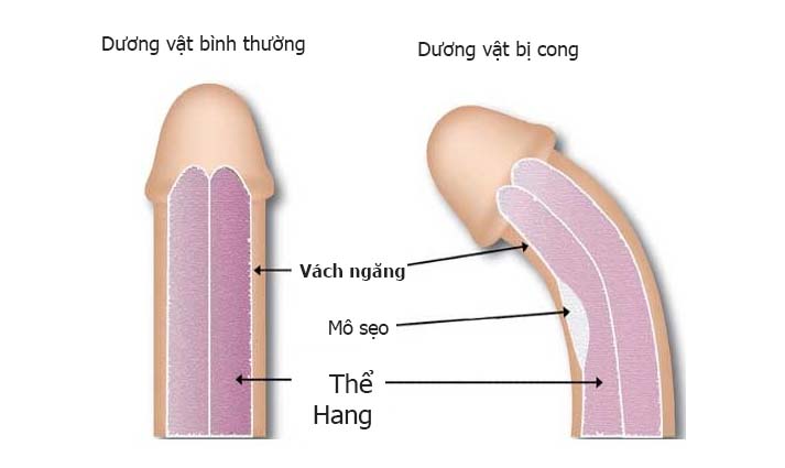 dương vật bị cong