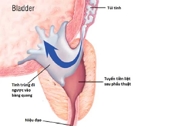 đi tiểu ra tinh dịch