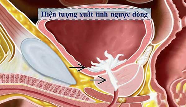đi tiểu ra tinh dịch do xuất tinh ngược