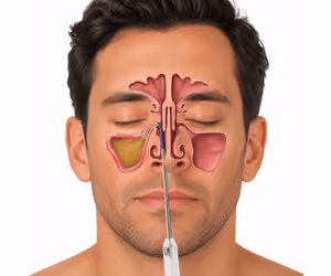Graphic of a man with mucus in his sinuses, undergoing the Balloon Sinuplasty surgery
