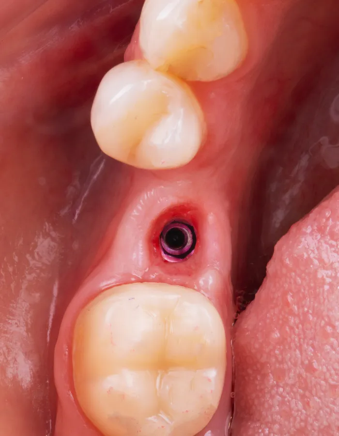 Zahnimplantat im Kiefer mit freiliegendem Implantatpfosten.