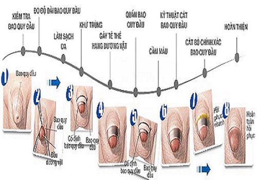 Káº¿t quáº£ hÃ¬nh áº£nh cho RÃ¡ch dÃ¢y tháº¯ng bao quy Äáº§u pháº£i lÃ m sao chá»¯a