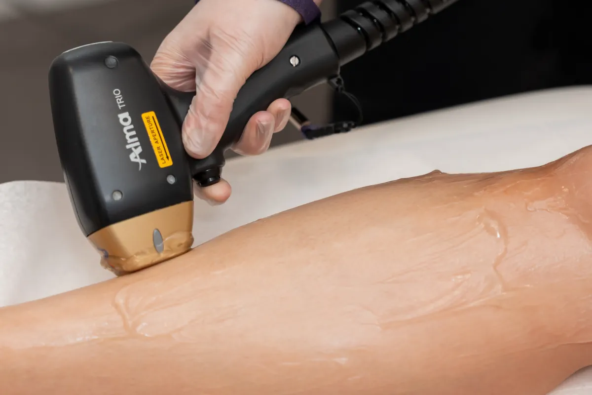 Soprano Ice laser hair removal treatment