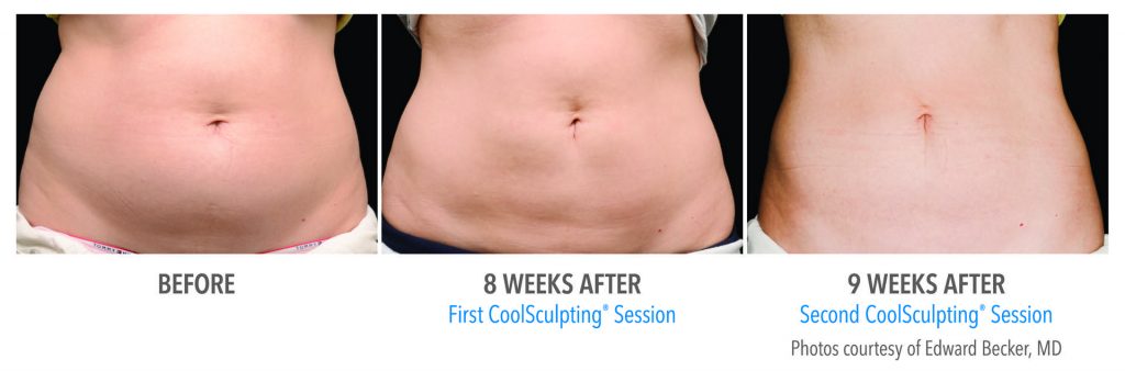 Photo of belly before vs after coolsculpting