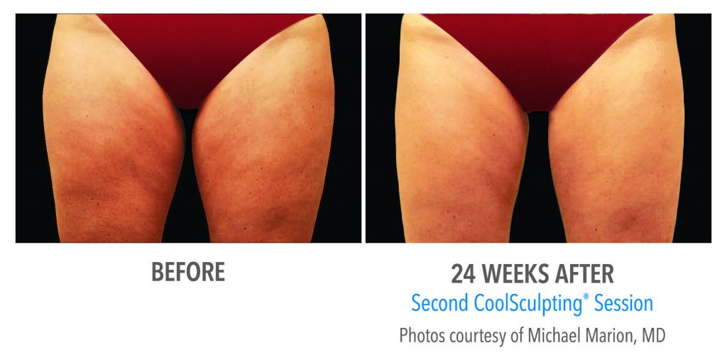 Photo of legs before vs after coolsculpting