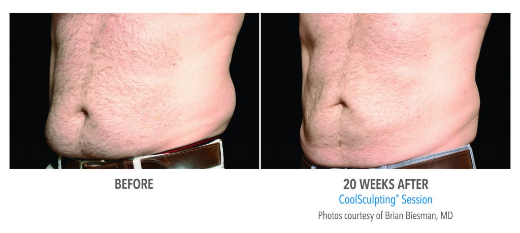 Photo of a man belly before vs after 20 weeks coolsculpting