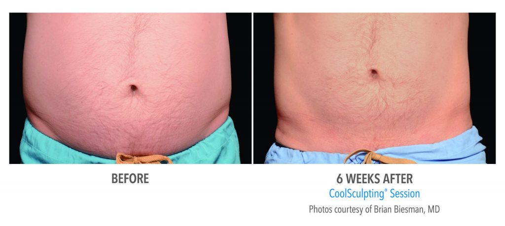 Photo of a man belly before vs after coolsculpting