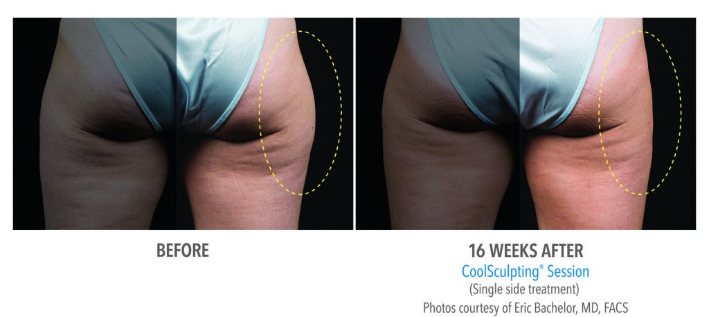Photo of a cheek before vs after coolsculpting