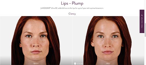 photo of a woman named Clancy before and after botox and juvederm injection