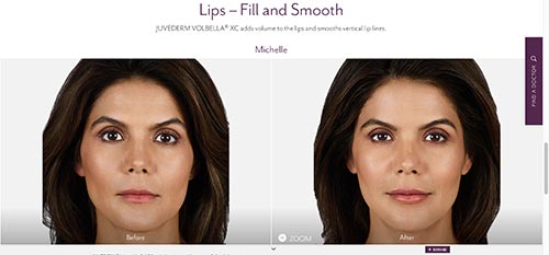 photo of a woman named Michelle before and after botox and juvederm injection