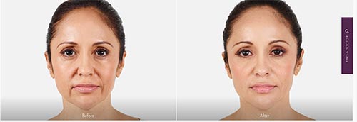photo of a woman before and after botox and juvederm injection