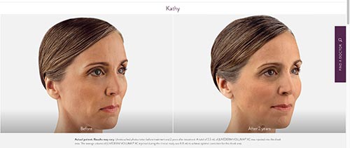 photo of a woman named Kathy before and after botox and juvederm injection